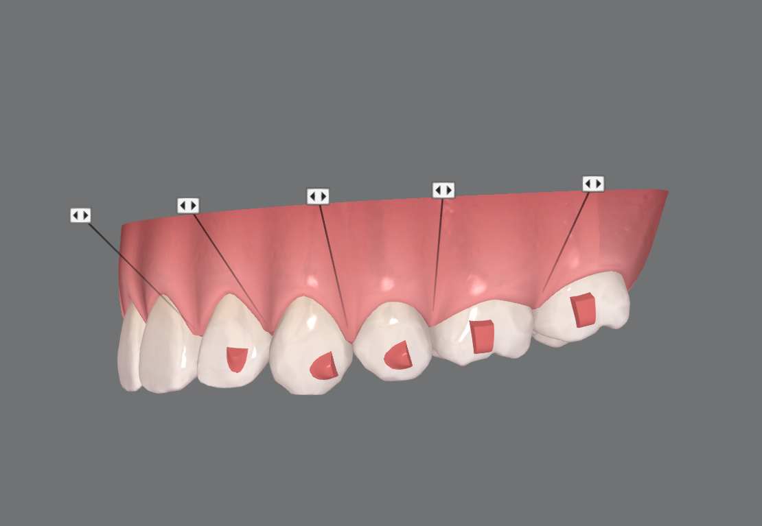 ¿Qué es el SmartForce de Invisalign?