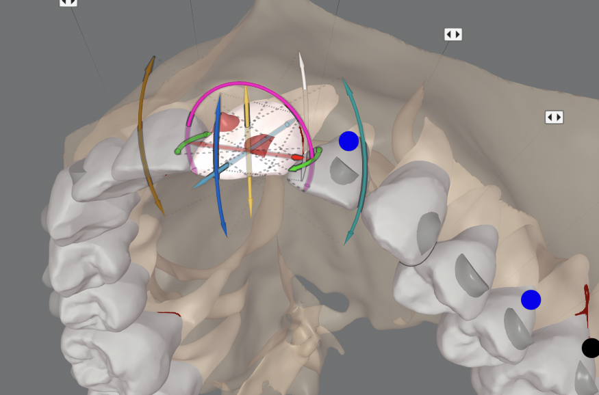 Movimiento dental con software ClinCheck