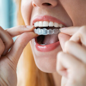 Ventajas de Invisalign