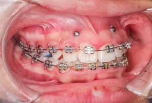 mini implantes ortodoncia