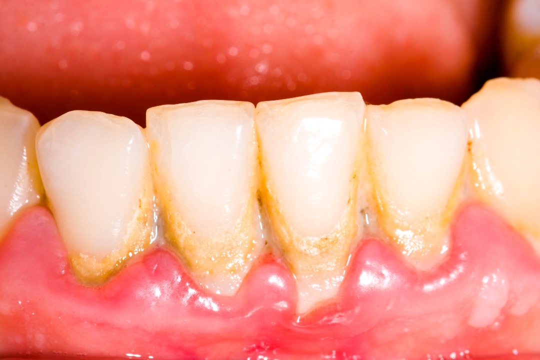 Cálculos dentales