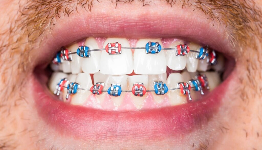 Ortodoncia correctiva: Imagen adulto con brackets