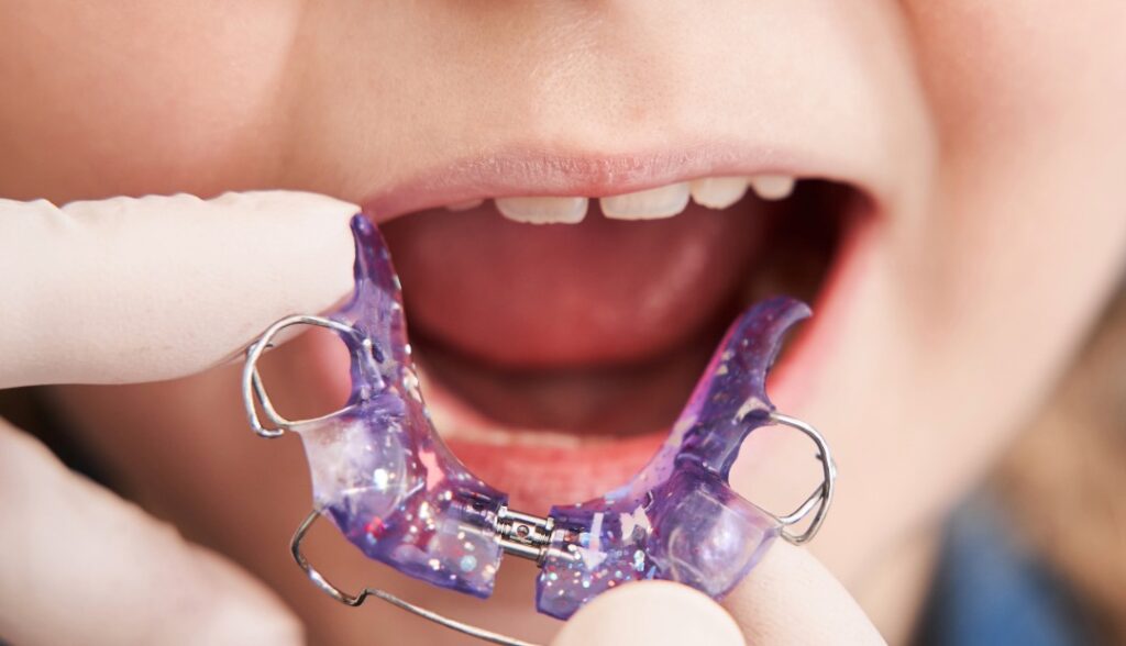 Ortodoncia Interceptiva: Imagen nin&Igrave;&fnof;o con aparato ortopedico