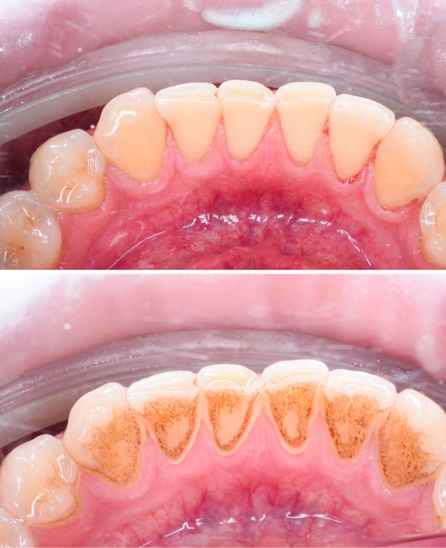 Antes y despuÃ©s limpieza dental