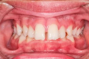 Diastema