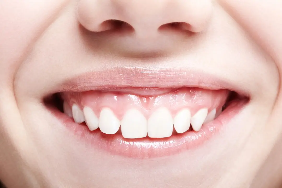 Sonrisa Gingival: Clave para tu Sonrisa Perfecta