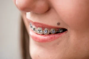 Brackets autoligado