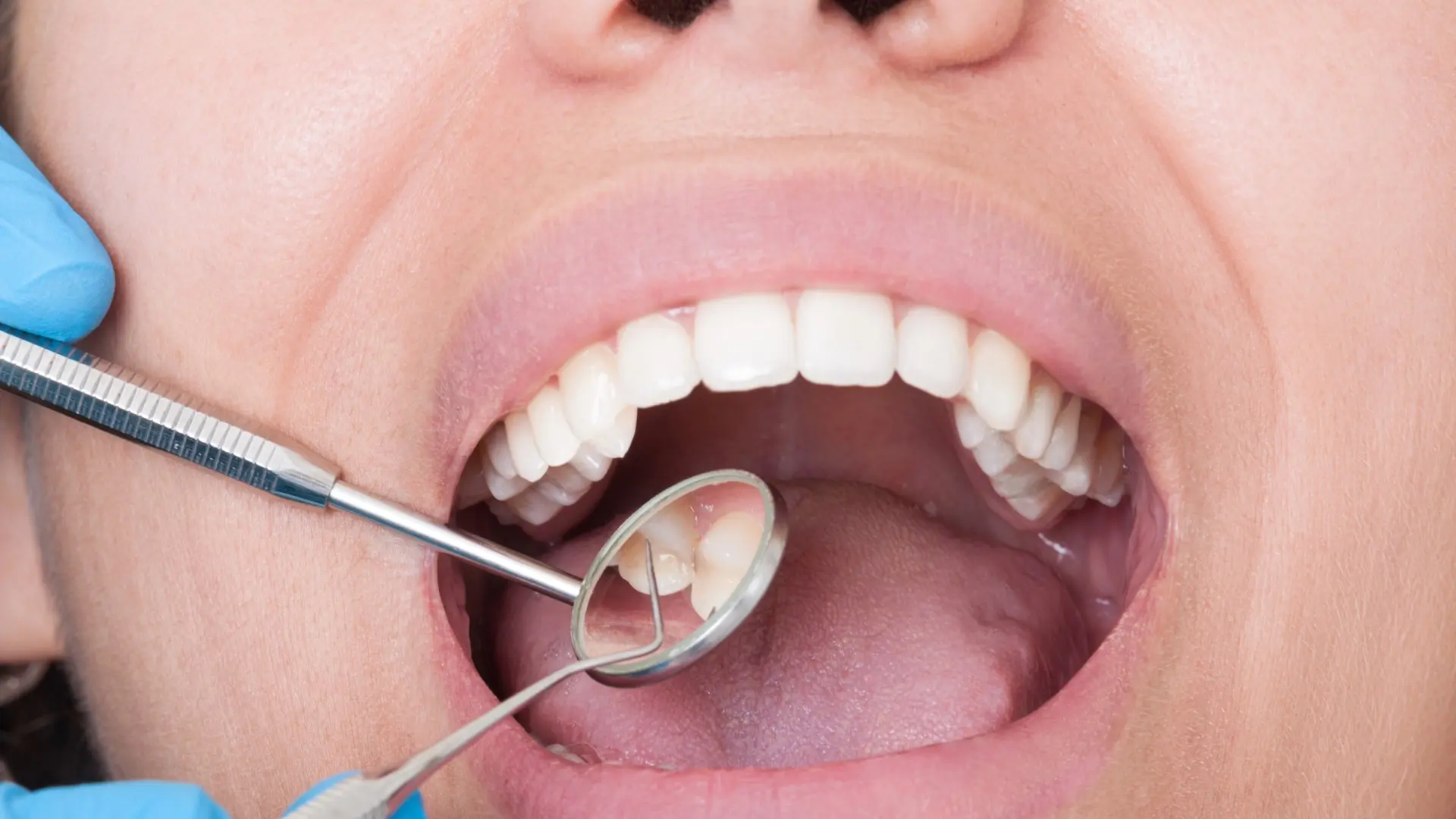 ¿Si Tengo Caries, Me Pueden Poner Brackets? NO, descubre más Aquí