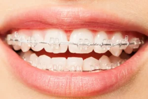 Brackets de Zafiro