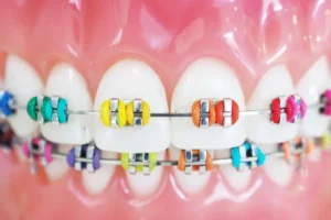 colores de brackets