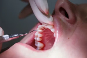 curetaje dental