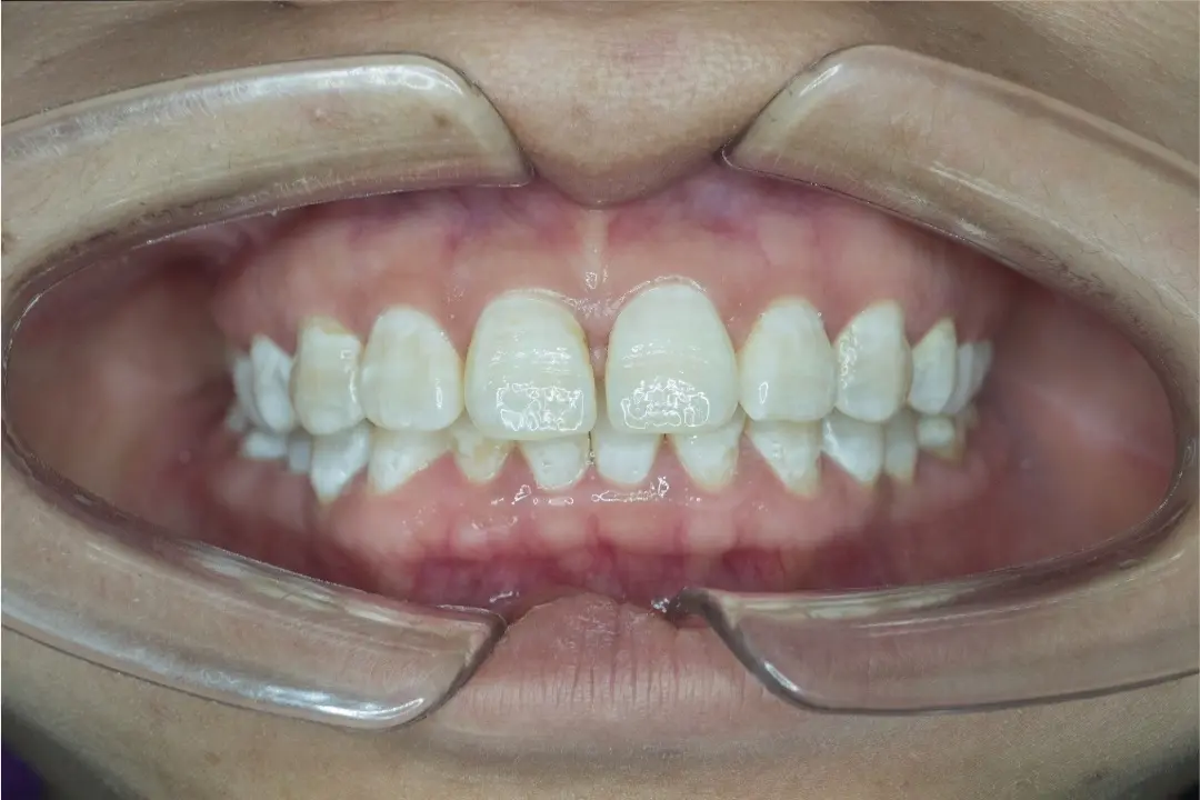 Dientes con manchas blancas
