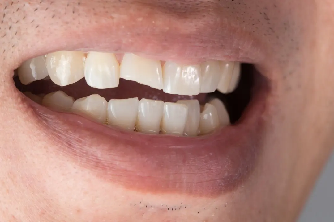 Fractura dental por piercing en la lengua