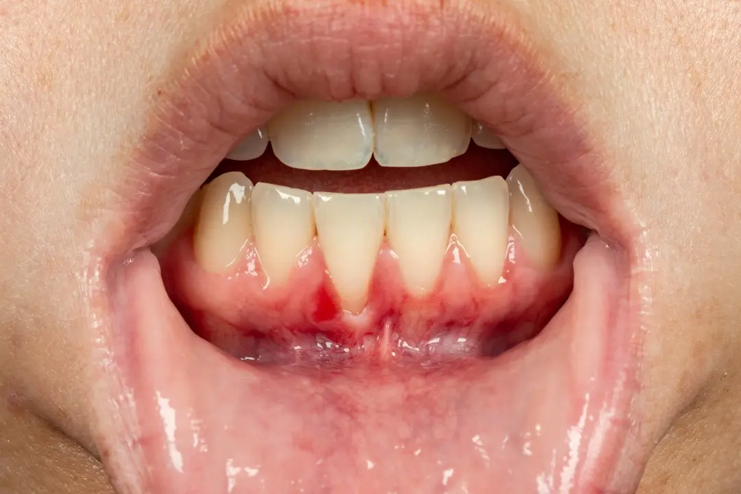 Recesión gingival por piercing en la lengua