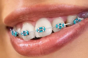 Color azul claro o celeste en los brackets