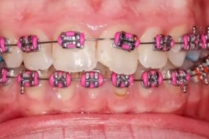 Color fucsia en brackets