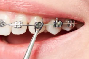 Color negro en los brackets