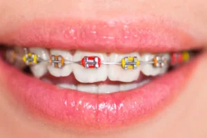 Color rojo y amarillo en brackets