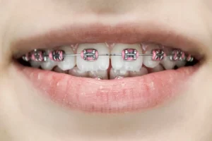 Color rosado en brackets