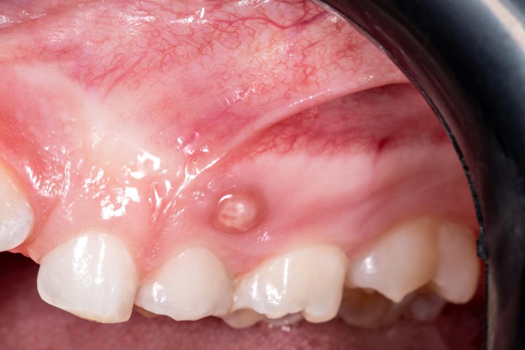 Absceso Periapical – Causas, síntomas y factores de riesgo