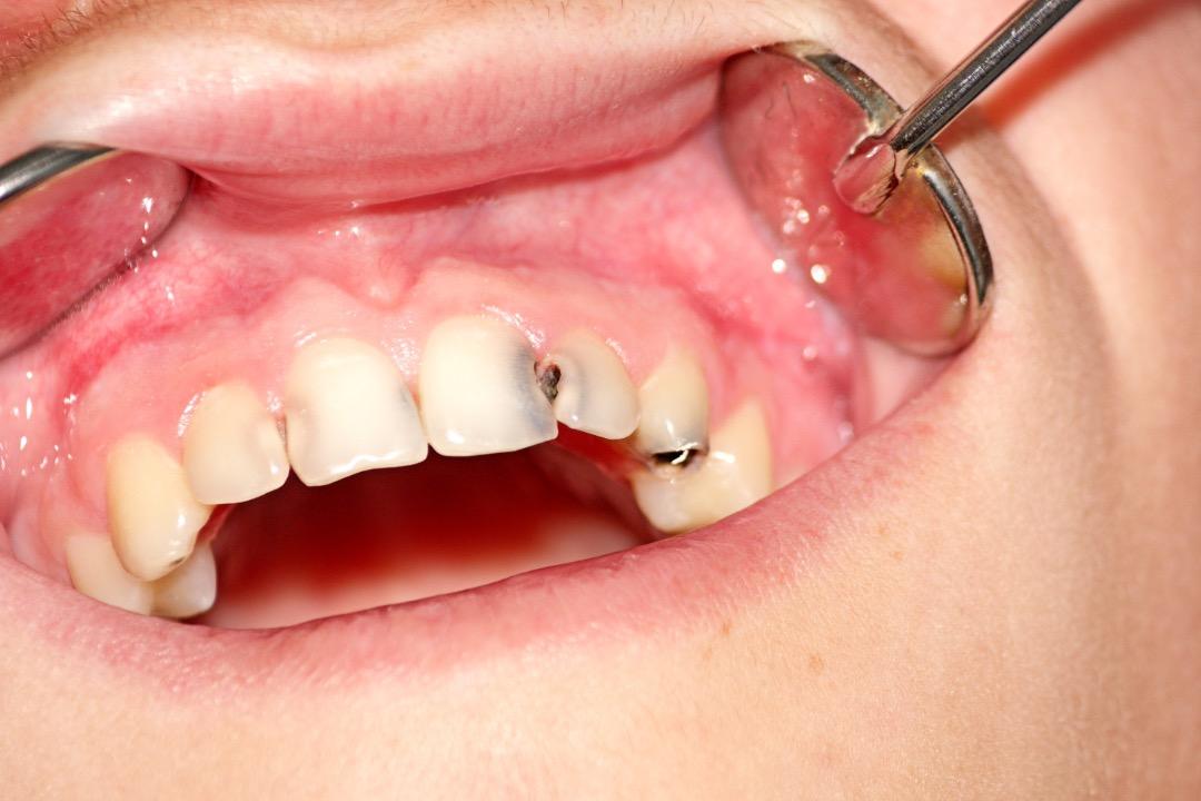 Caries – Causas, síntomas y factores de riesgo