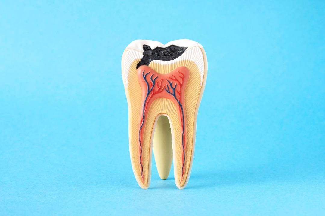 ¿Cuánto demora una caries en llegar al nervio? Ten cuidado