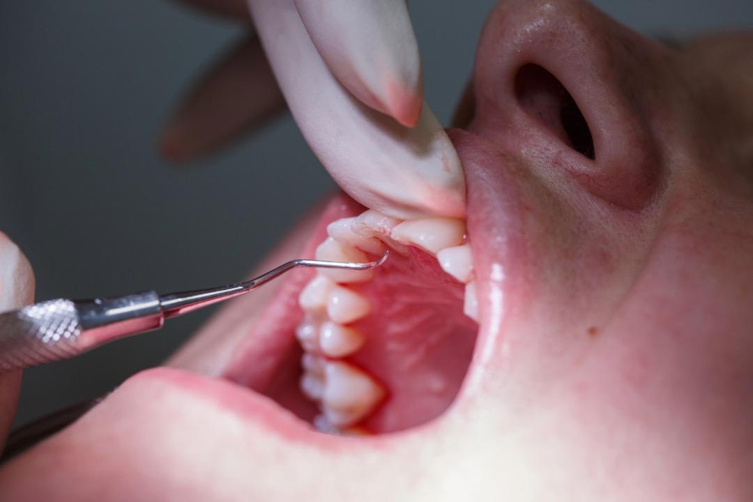 Curetaje Dental – Qué es, importancia, procedimiento y cuándo es necesario