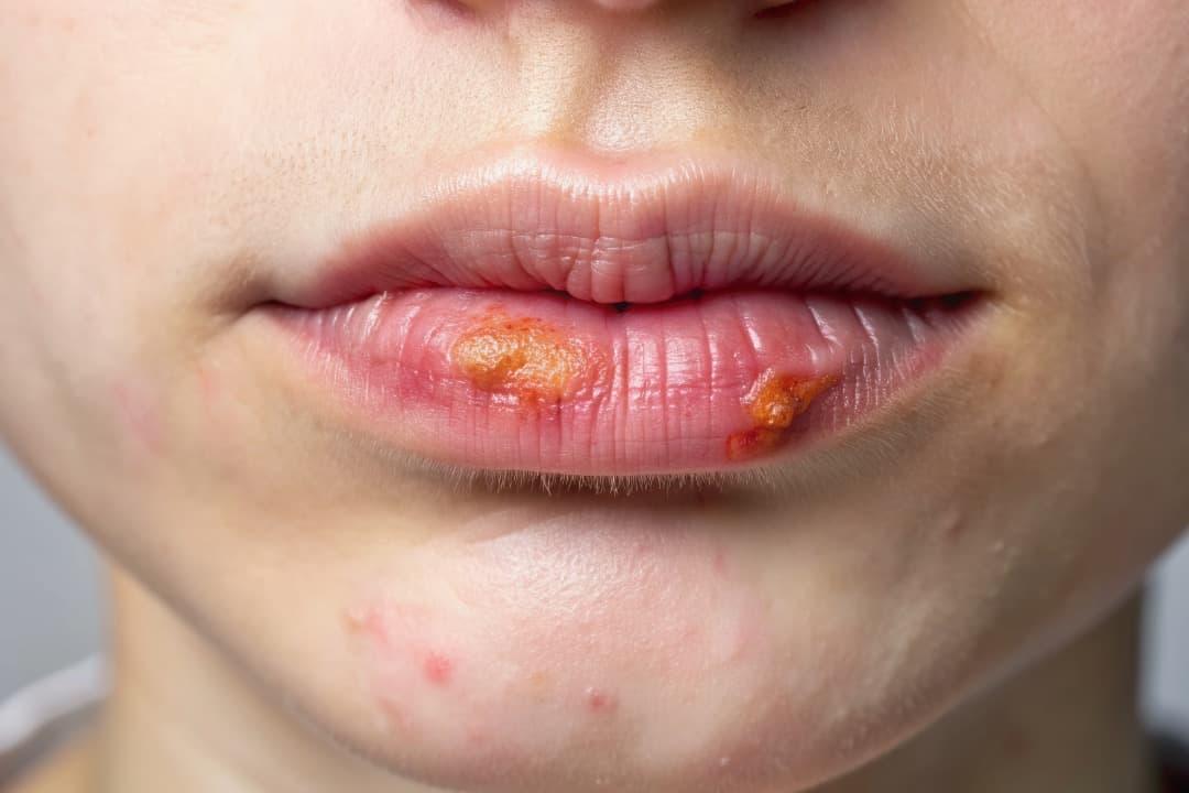 Herpes Labial