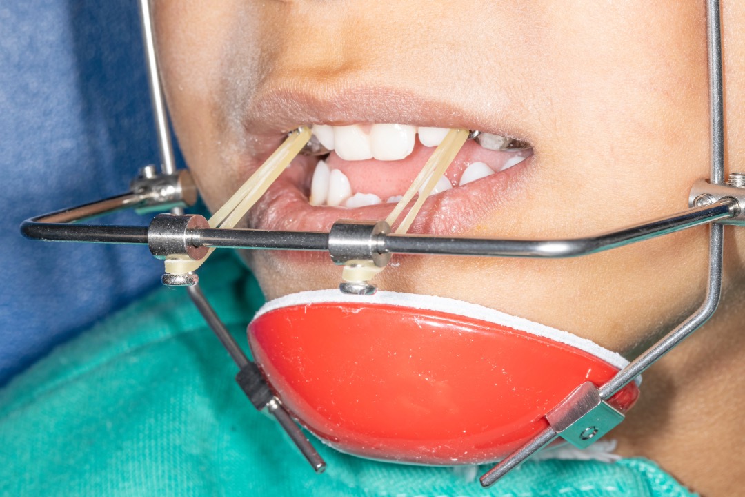 Máscara Facial