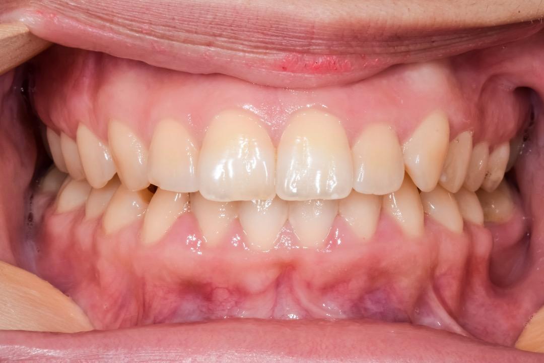 Oclusión Dental – Qué es, tipos e importancia de una correcta oclusión