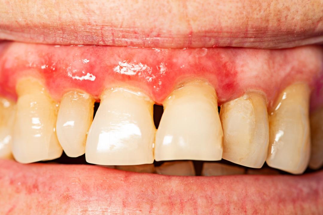 Periodontitis – Causas, síntomas y factores de riesgo