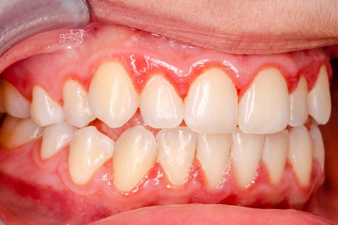 Gingivitis – Causas, síntomas y factores de riesgo