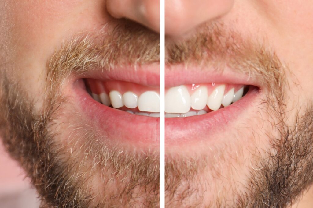 Gingivectomía antes y después