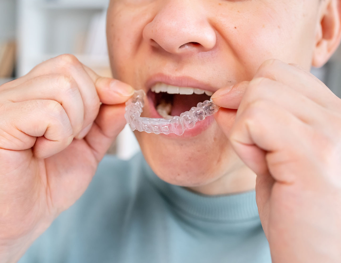 ¿Invisalign Duele? Te lo cuento todo