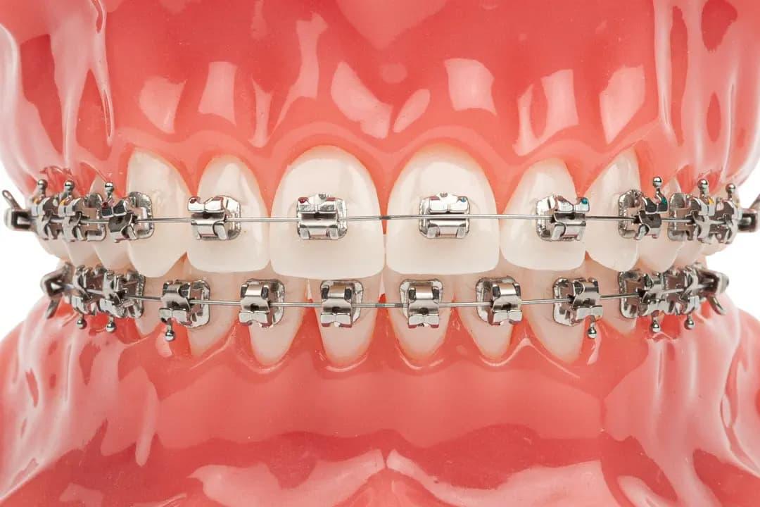 Brackets Autoligado