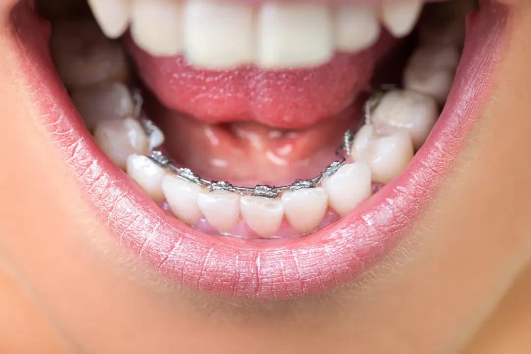 Brackets Linguales