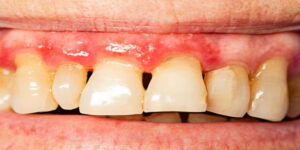 Periodontitis