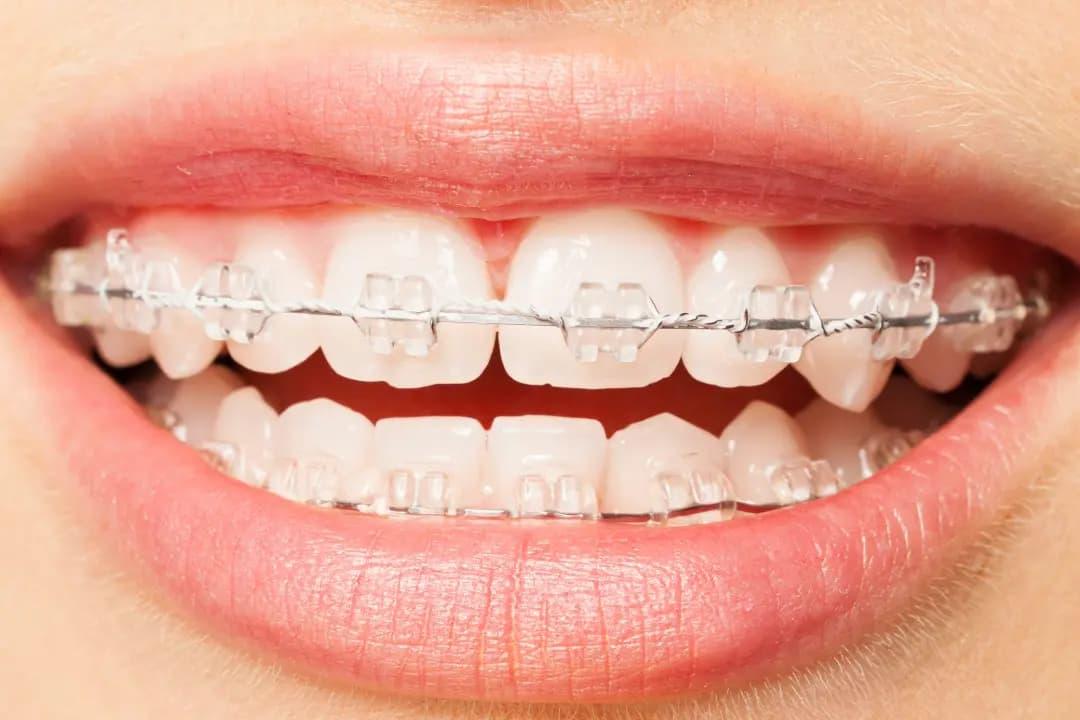 Brackets Zafiro
