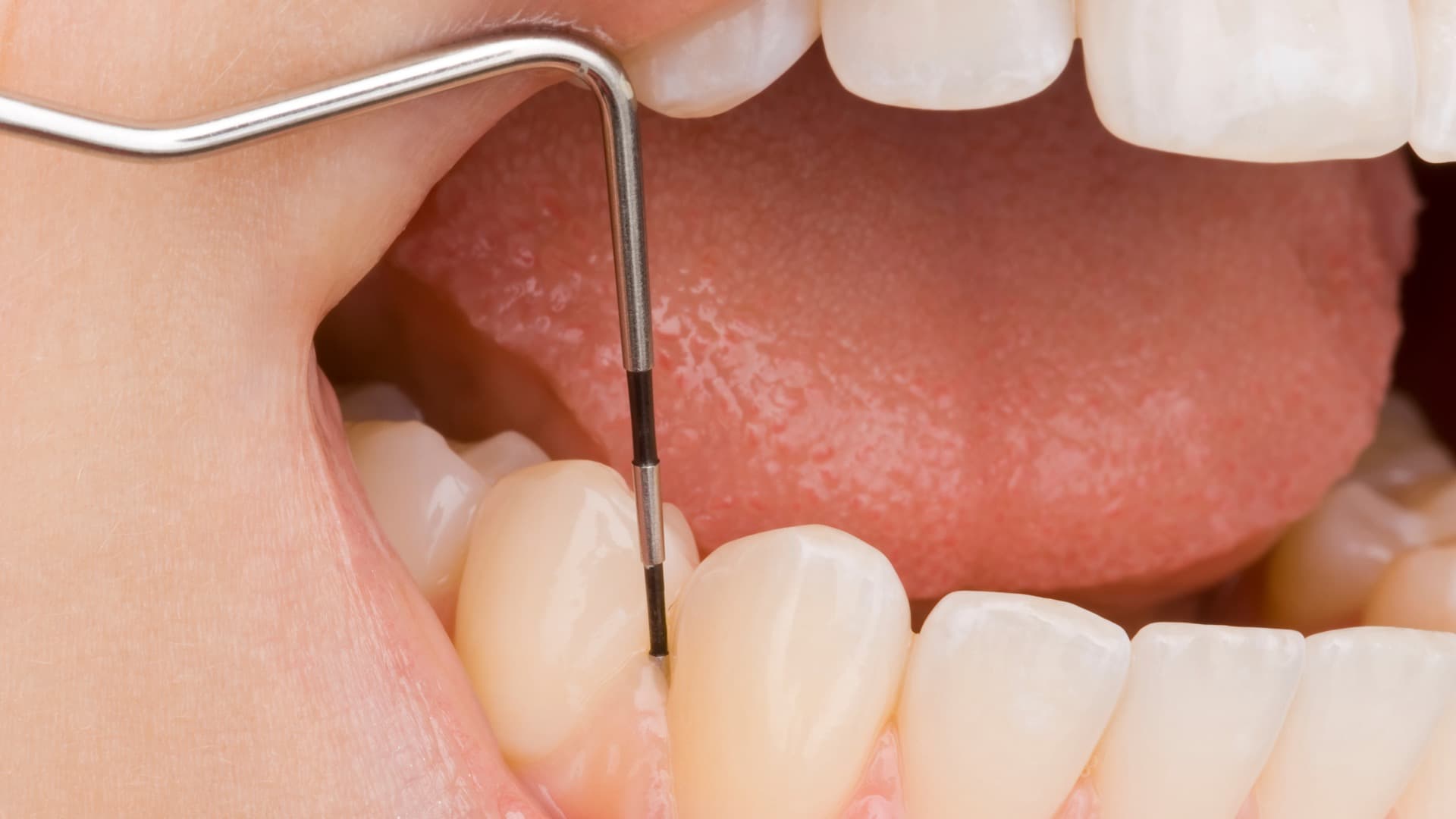 Periodontitis – Diagnóstico