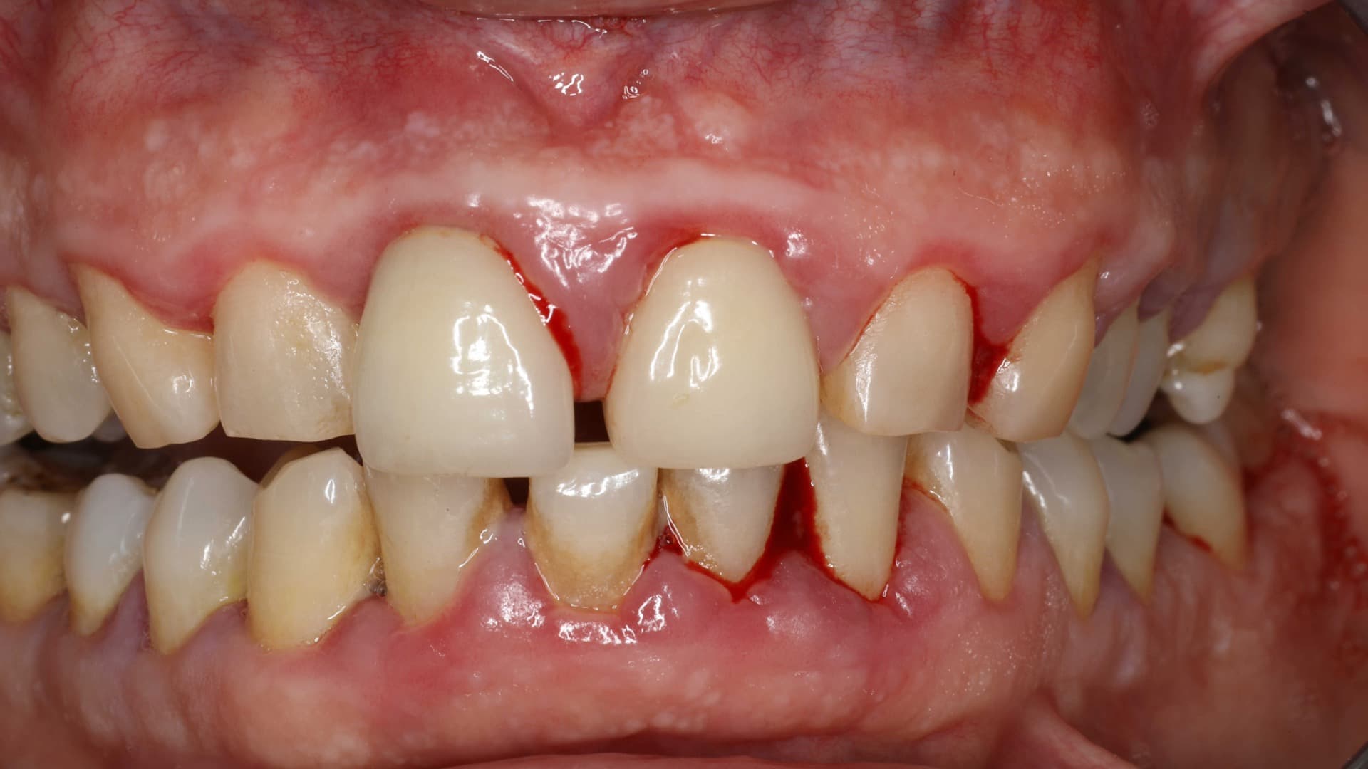 Periodontitis – Tratamiento