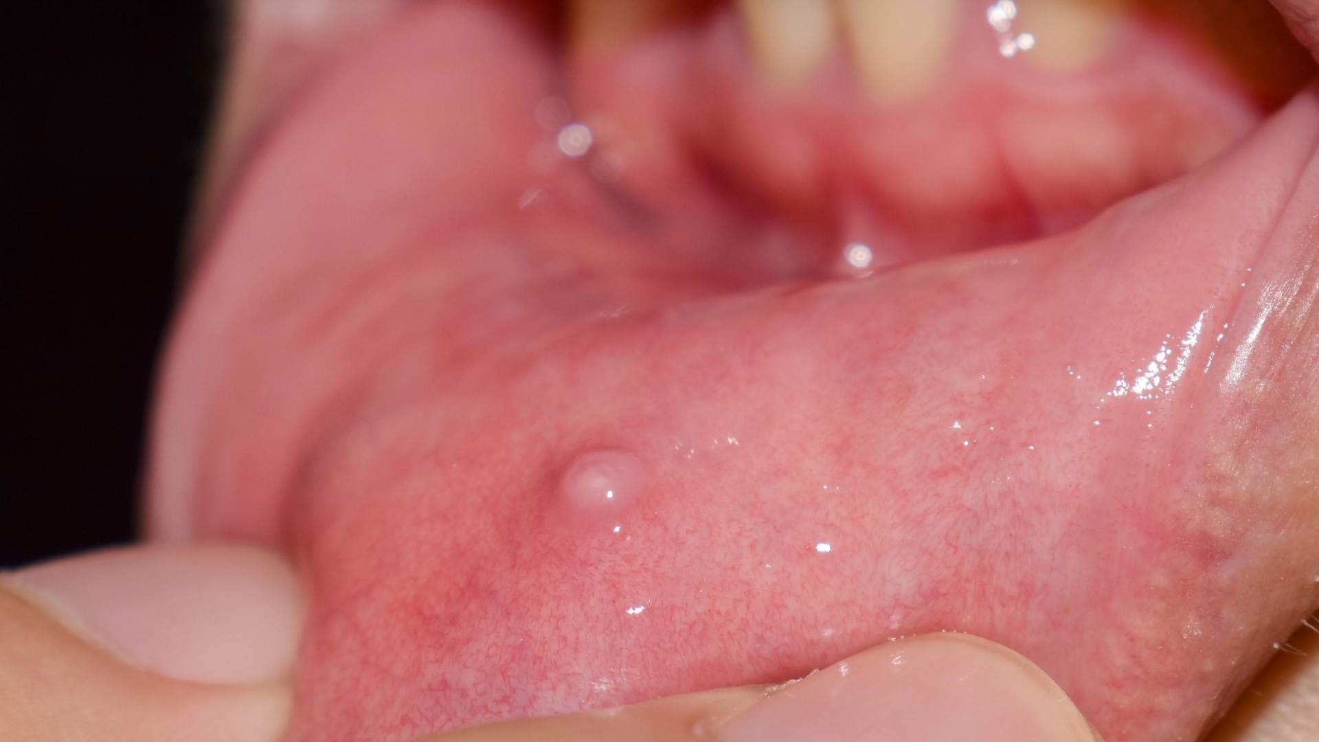 Mucocele