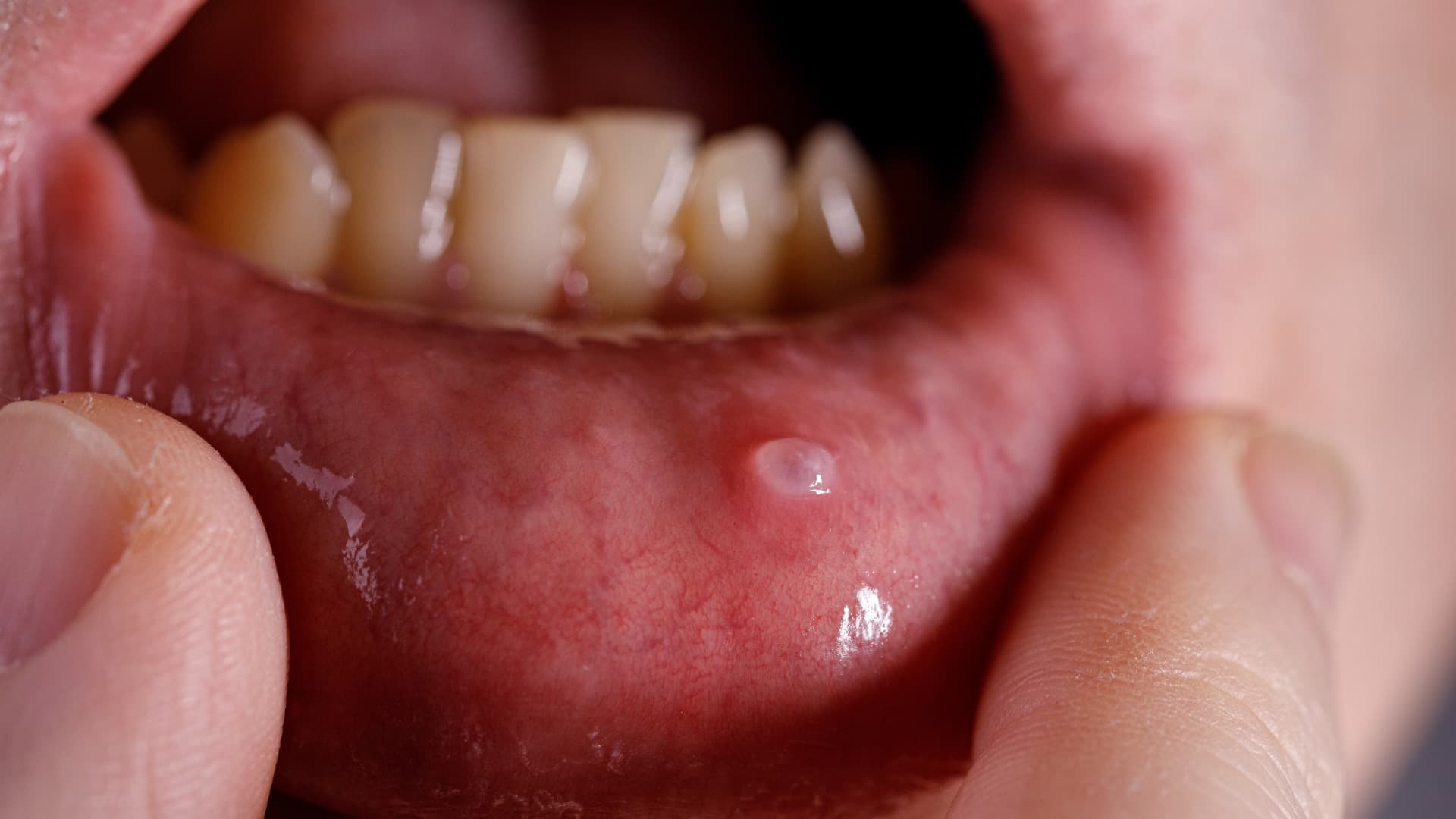 Mucocele