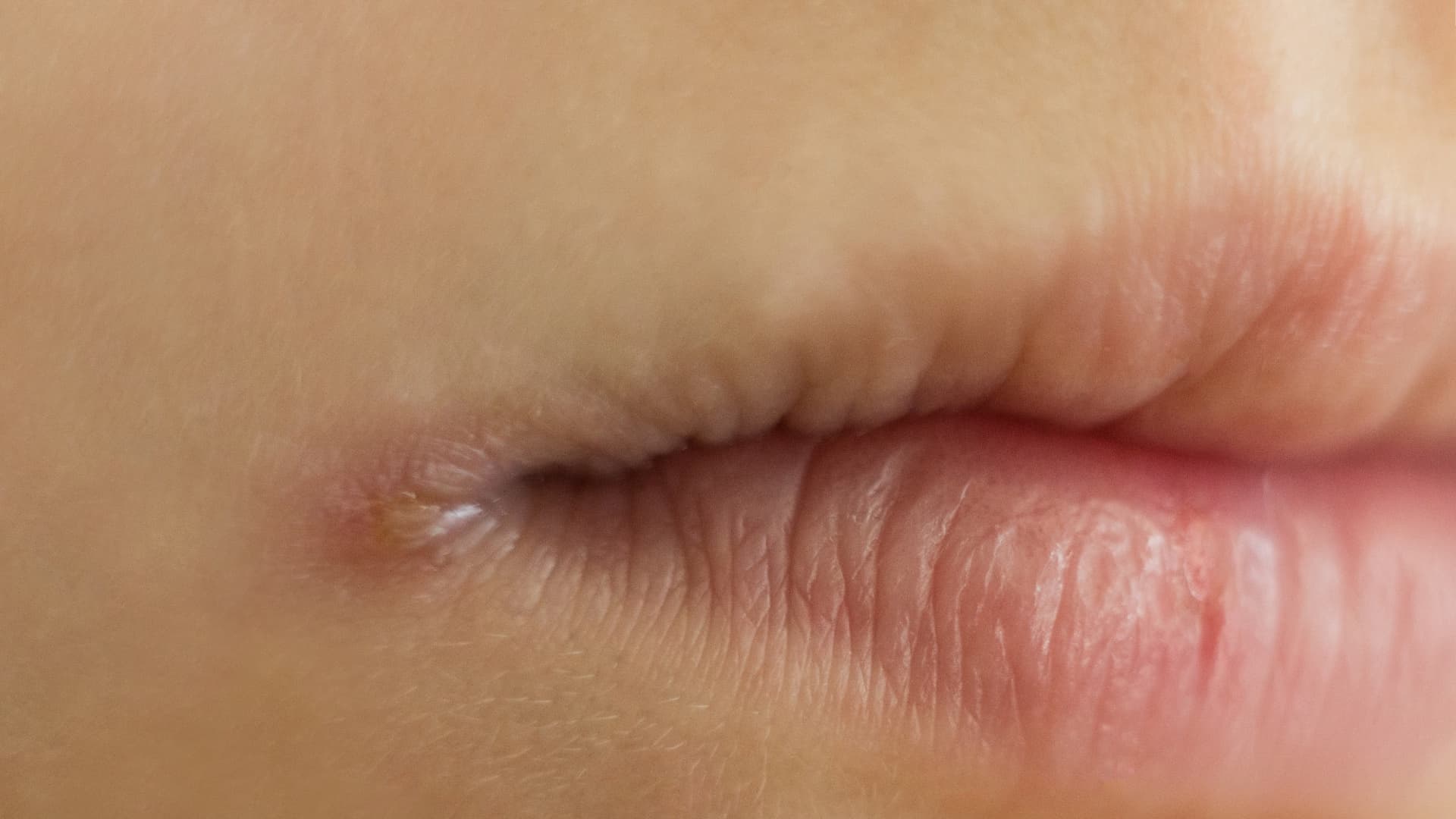 Queilitis Angular