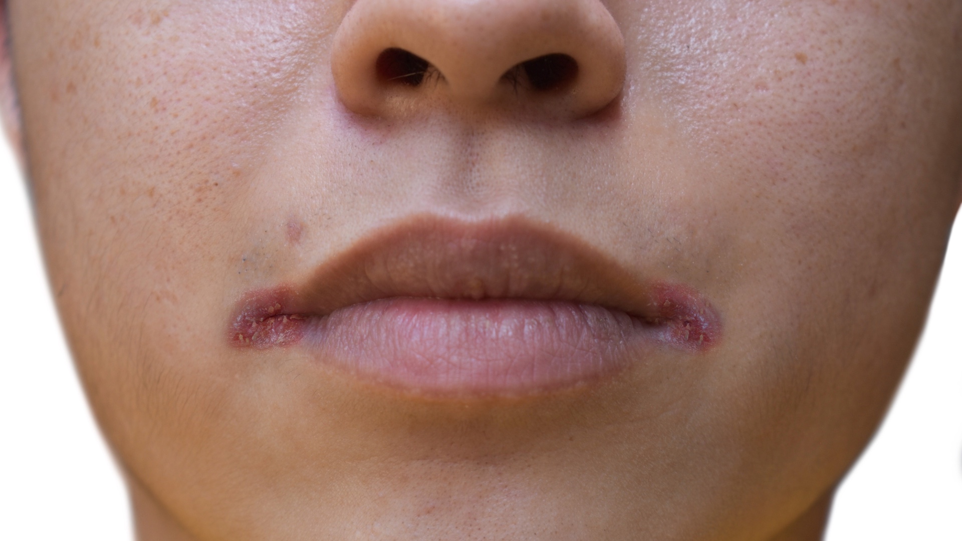 Queilitis angular
